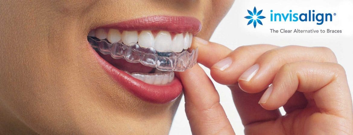 Invisible Braces Calgary, Affordable Braces