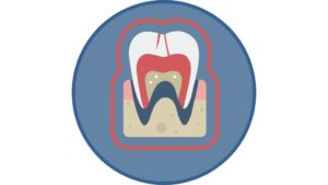 tooth removal calgary se
