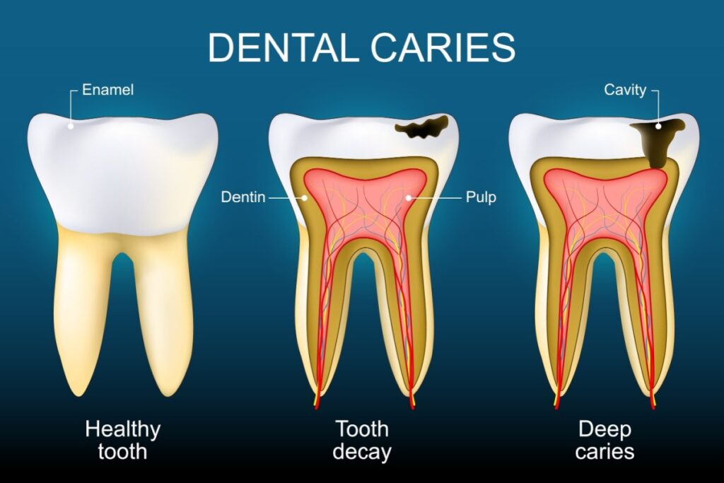dental caries infographic design